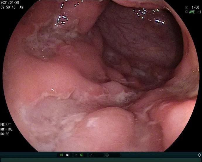 腹泻|从无锡治到上海，这个宝宝的“急性肠炎”不一般