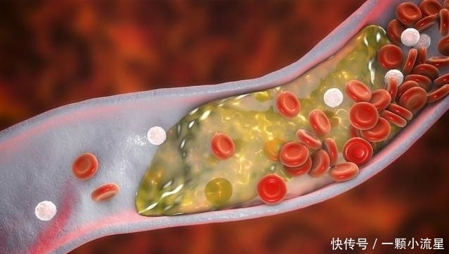 远离|年龄越大血管越堵,1种叶子常泡水喝,通血管,远离血栓困扰!