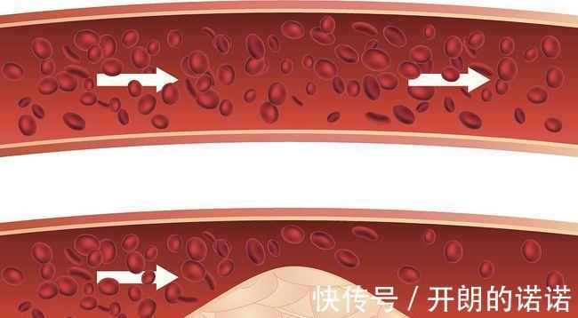 服用|做血脂检查应该注意哪几点检查单的4个指标，或不容忽视
