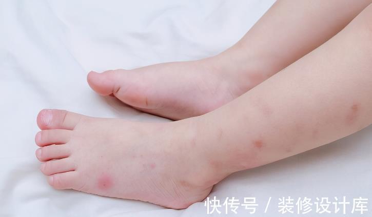宝宝|宝宝被蚊子叮咬后,红肿长时间不消退,是怎么回事?该怎么办