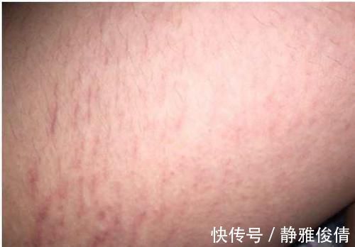 糖尿病|不管男女,脚出现3种异常,可能是糖尿病早期症状,别忽视