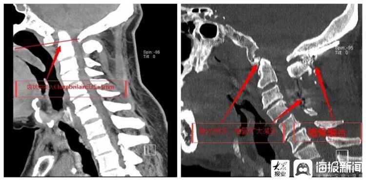 寰枕|高难度！枣庄市立医院成功完成一例颅底凹陷症手术治疗