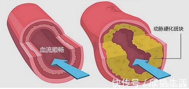 高血脂患者|中医院士提醒常吃1种“零食”，给血管来个大扫除，清理高血脂