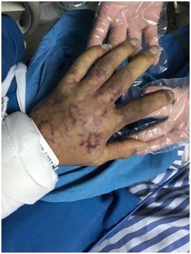 呼吸机|身上爬满红色蛛网，气道壁长出黑色锈斑，33岁的他遭遇生死劫，死里逃生