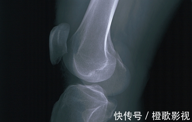 脆骨剂|30岁女子产后骨折,提醒:这3物或许是“脆骨剂”,别贪吃