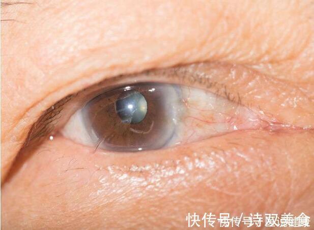 脑血栓|糖尿病不可怕,但血糖一旦失控,诱发的4种并发症很“要命”!