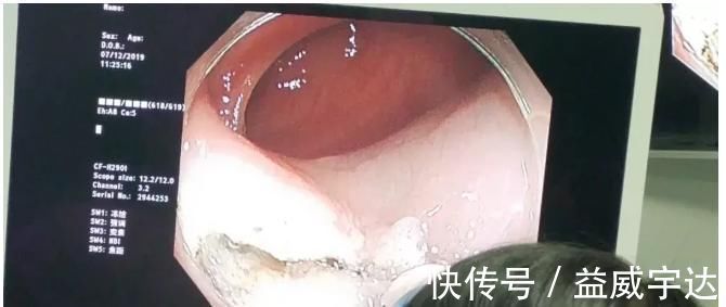 上皮内瘤变|胃镜查出来“上皮内瘤变”,是癌吗?该怎么办?