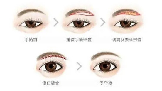 医院 做双眼皮手术年纪大了以后会变成什么模样?