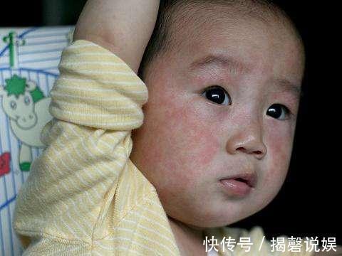 皮疹|宝宝出现9个特点,可能是患急疹了,教你5个方法,在家就能护理