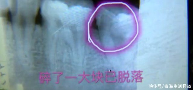 紫薯糯米球里“藏”钢珠，男子一口咬下去牙磕坏，怒索赔12万!