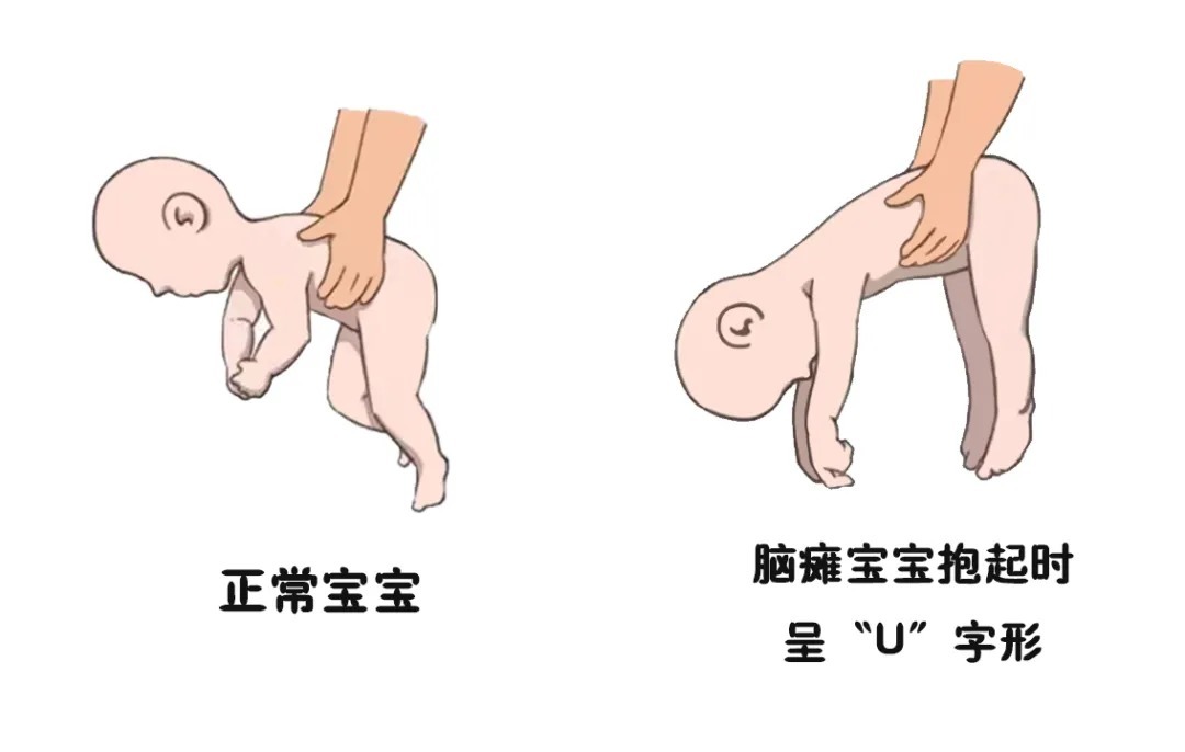 儿童|天使科普：10种方式判断脑瘫儿童的早期症状