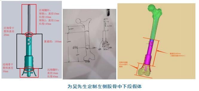 覃健|44岁木工查出恶性骨瘤，3D打印为他量身定制股骨假体