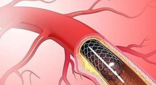 心脏支架手术后,还可以活多久医生终于