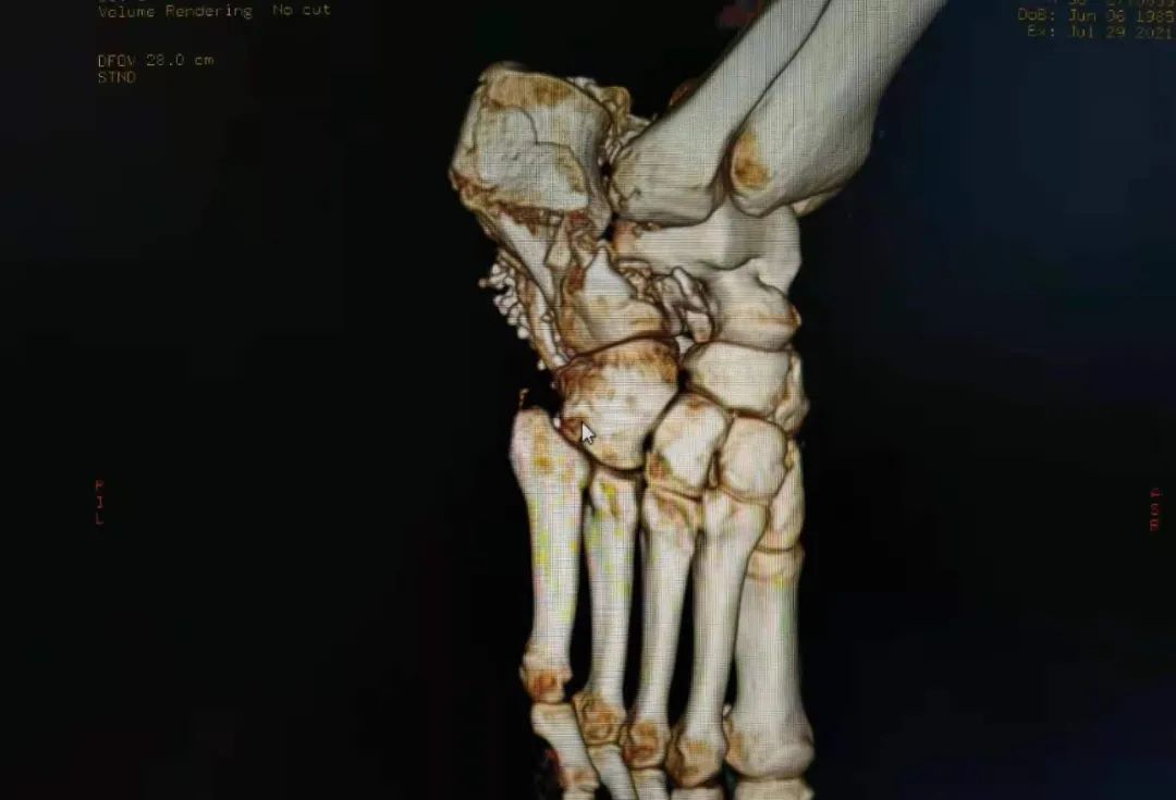 胆囊切除|山东第一医科大学附属省立医院成功救治一名高空坠落伤患者