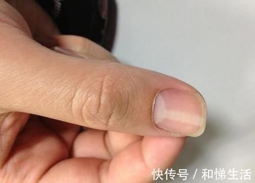 指甲|手上出现这9个表现,可能是体内疾病发出的求救信号,别不当回事!