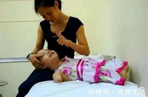 畸形|孕检发现娃是畸形,宝妈不顾劝阻坚持生下,如今将女儿养成公主