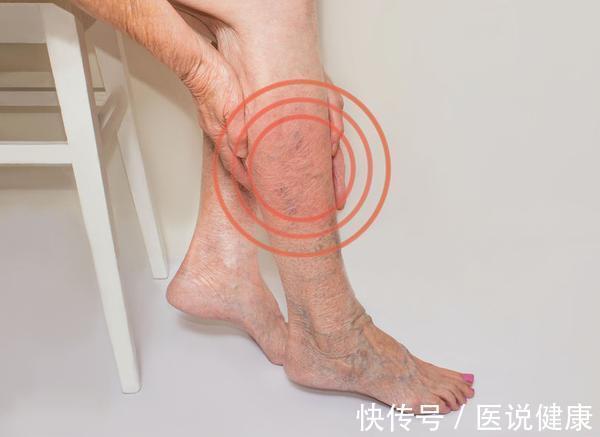 腿脚|血管好不好,看腿脚,这3种异常迹象,出现一个,也要重视起来!