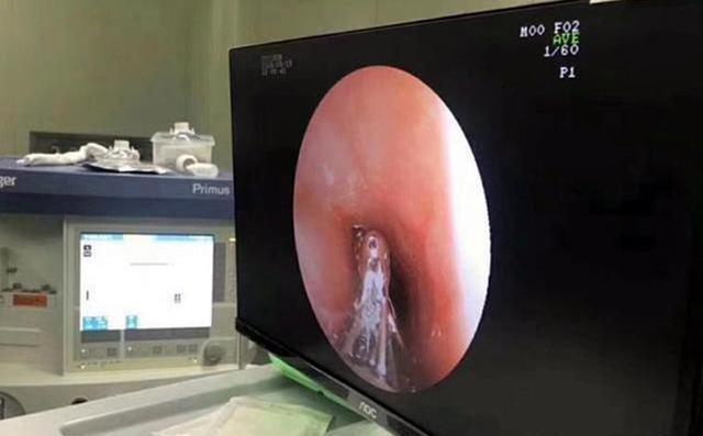 幕后黑手|男孩腹痛干呕,查出胃里有团“胶”,幕后黑手是想不到的健康食品