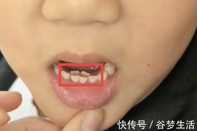 刷牙|7岁男孩长了“双排牙”,需要一颗一颗拔掉,奶奶自责不已