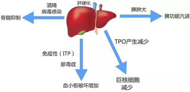 一文掌握肝硬化并发血小板减少的原因和治疗手段温故知新