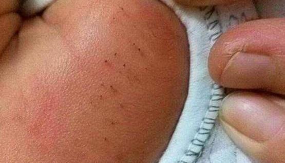 生病|宝宝身上长“小黑虫”,妈妈用心一颗颗拔掉,不料孩子被送去抢救