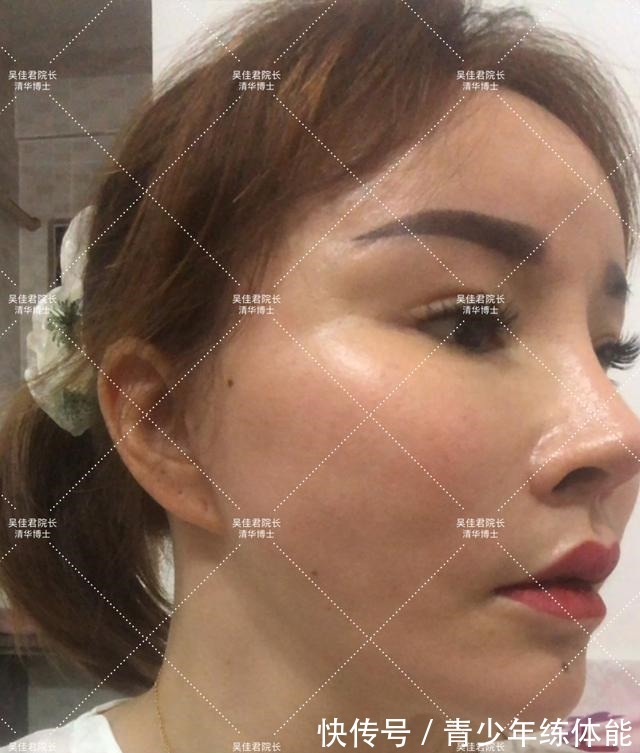 拉皮 小拉皮术后6个月,让她从老阿姨逆袭小姐姐!