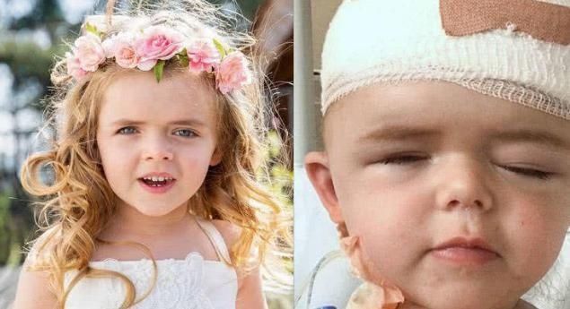 ell女孩生下来就“整容”,被医生打碎骨头重造,如今5岁美出天际