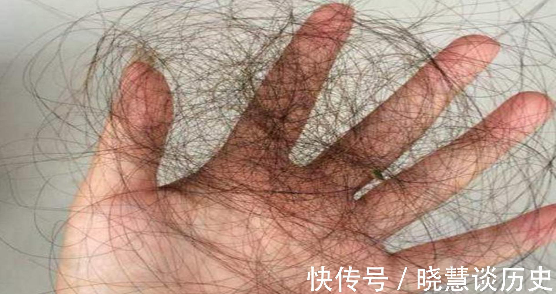 基因|每天掉超过100根头发是脱发？脱发5大元凶，少碰为妙