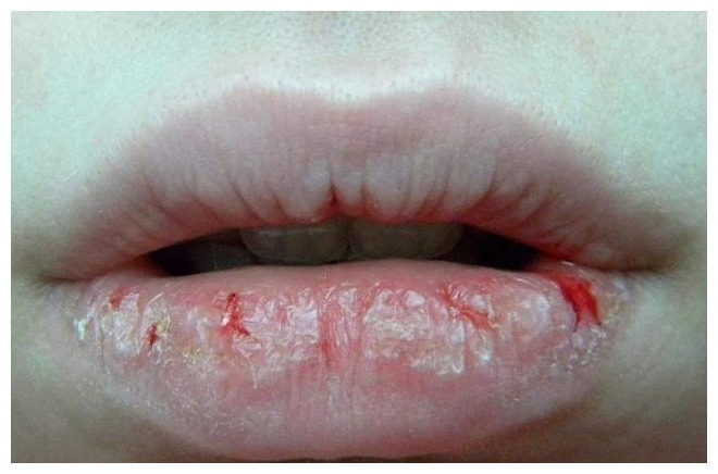 女人们|有妇科病的女人,嘴巴可能有这四种现象,希望你一个都不占