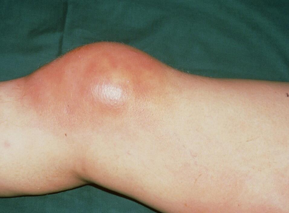 仙人掌+橘皮,不到两周,腿疼和积液都消失了,滑膜炎不攻自破