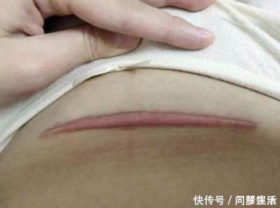 女性身体|剖腹产的伤口，对女性身体会不会产生伤害，妇产科医生说出真相