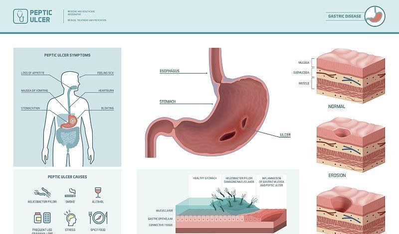 远离幽门螺杆菌,请记住,吃饭三不要,早晚两坚持,胃癌才会更远