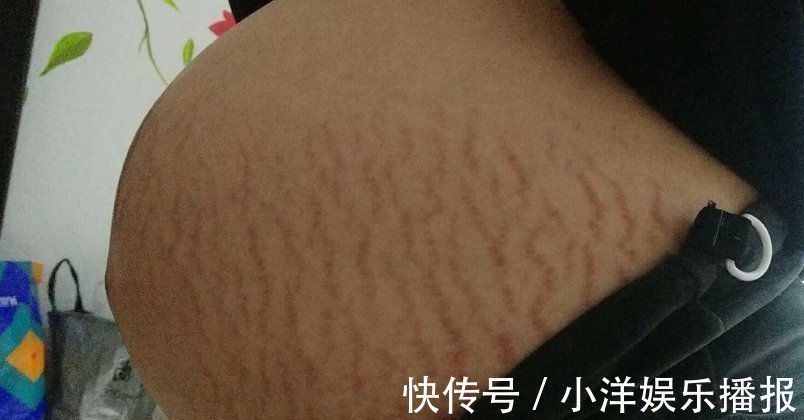 妊娠纹|怀孕7个月的孕妈每天抹油,但还是长了妊娠纹,医生的一句话扎心了