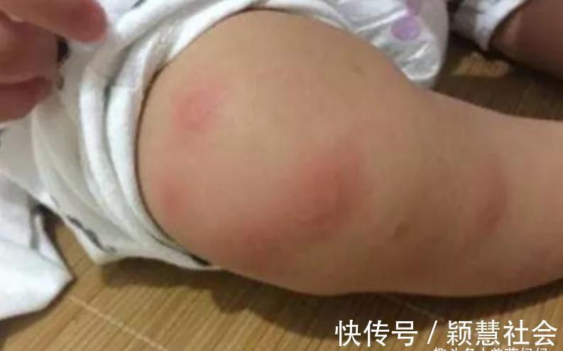 捕蚊|宝宝被蚊子叮咬后,第一步不是帮娃止痒,很多家长都做错了
