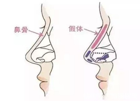 注射隆鼻 隆鼻手术一般多少钱？隆鼻能保持多久？