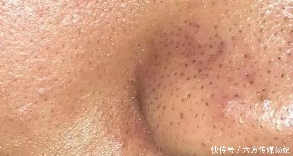 皮肤|黑头1挤1个洞,紧致毛孔是关键!