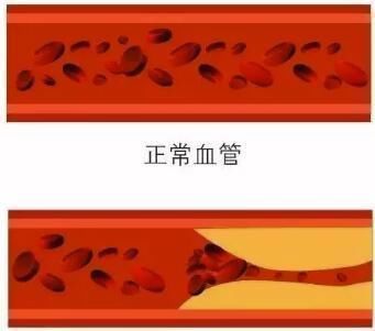 三位院士声明开水里加一勺,连喝15天,血管通透明亮,血脂悄悄