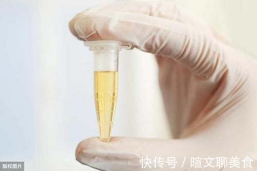 微血管|糖尿病人尿中泡沫多,可能肾脏伤的不轻,学会5招,远离尿毒症