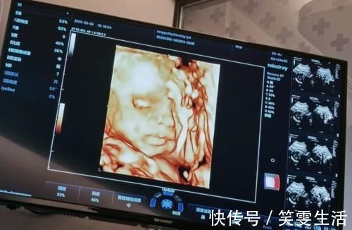 四维彩超|老公陪孕妈做四维，结果不让进，为啥四维检查贴着“家属止步”？