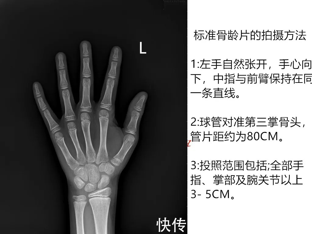 生长发育|天使科普：4个骨龄小知识，告诉你关于长高的那些事