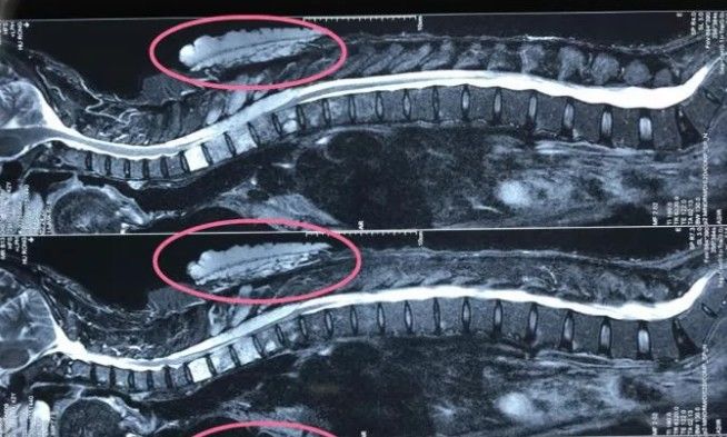 椎体|男子胎记越长越大,最后瘫痪