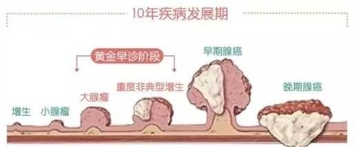 腺瘤息肉|毫无症状镜检出结肠腺癌,40岁以上人群尤其需要注意
