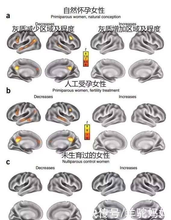 脑容量|你相信“一孕傻三年”吗研究发现怀孕会改变大脑,做女人真难