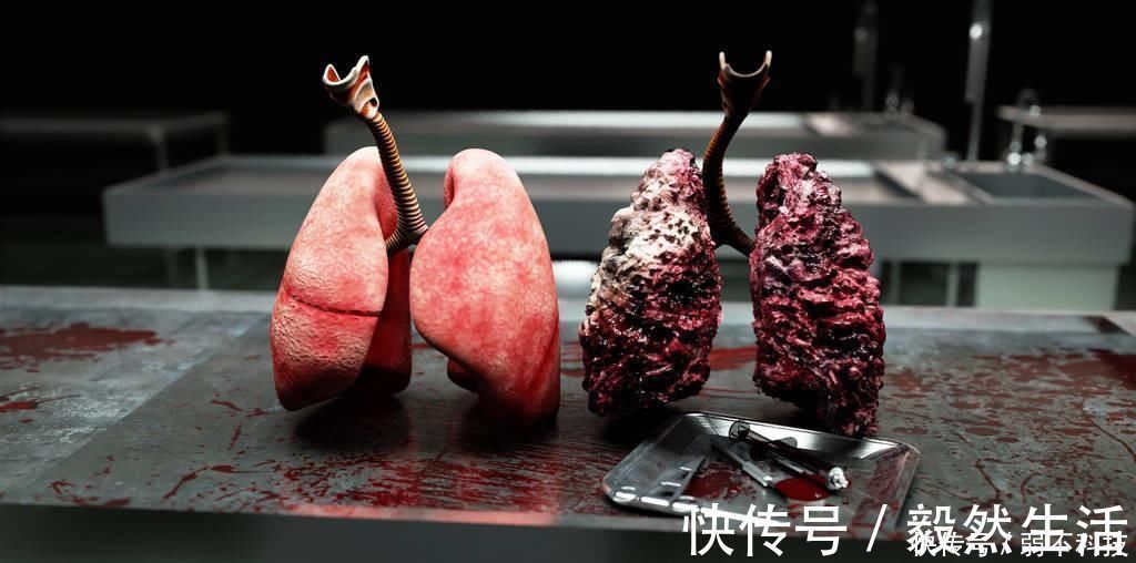 骨痛|吸烟者，身体一旦出现“1大2痛”，八成是肺癌上身，具体指什么