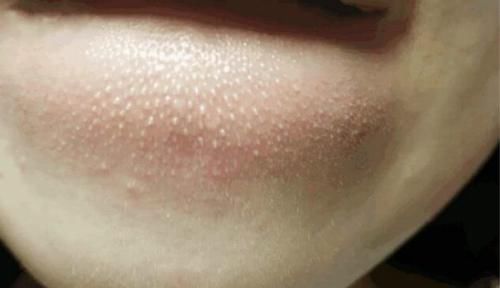 为何下巴长了很多小疙瘩？教你2个实用方法，快速去除小疙瘩