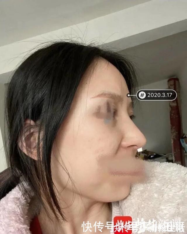 昆山 女子整容后山根晃动、鼻尖发白!手术方:很成功,已起诉