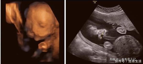 妻子怀孕看B超以为双胞胎，欣喜若狂，但孩子出生后，全家乱了套