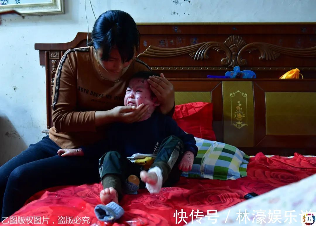 纱布|男童出生患罕见病,三年用掉纱布5000多圈,每天只能坐在床上