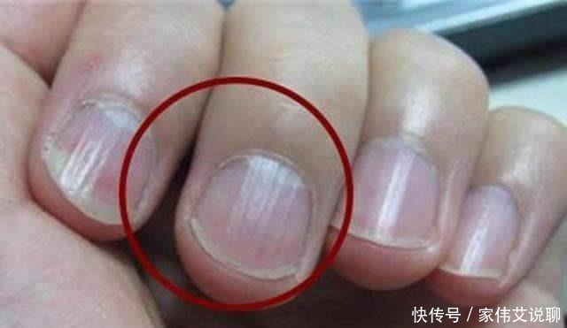 无论男女,指甲有“竖纹”,医生:八成是3个因素所致,可自测!