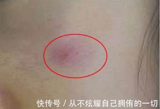 痘痘|烂脸预警!这3个让你变丑的护肤习惯,你可能每天都在做,难怪皮肤不好